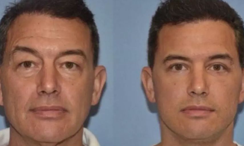 Herkes bu estetik cerrahını konuşuyor: Gençleştirme ameliyatı sonrası artık oğlundan daha genç görünüyor!