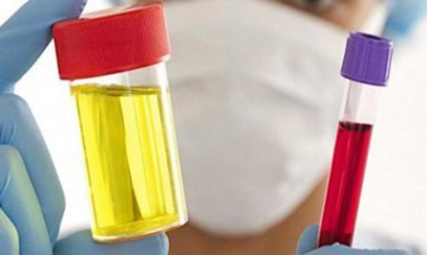 İdrarda Hemoglobin nedir, neden yükselir? Hemoglobin yükselme belirtileri