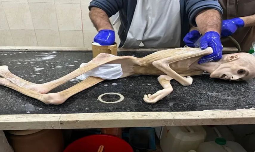 İsrail’in insanlık dramı pes dedirtti! Filistinli Yezen’den geriye bir deri bir kemik fotoğrafları kaldı…