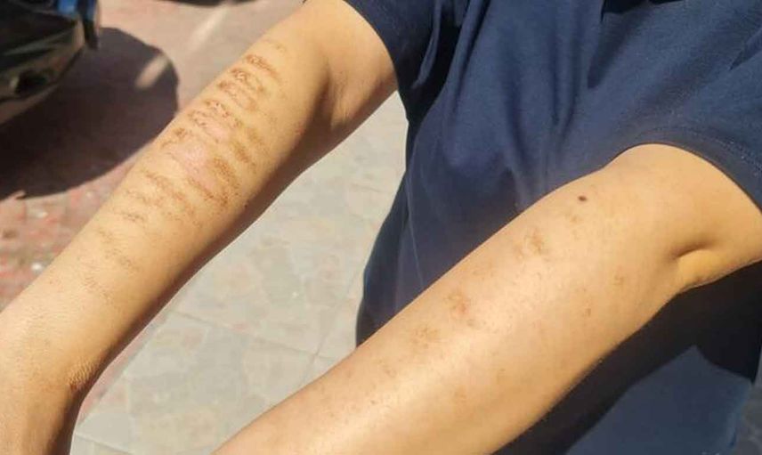 İzmit'te skandal olay: Epilasyon için gittiği güzellik merkezinde kolları yandı!