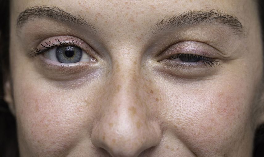 Myasthenia Gravis Nedir?