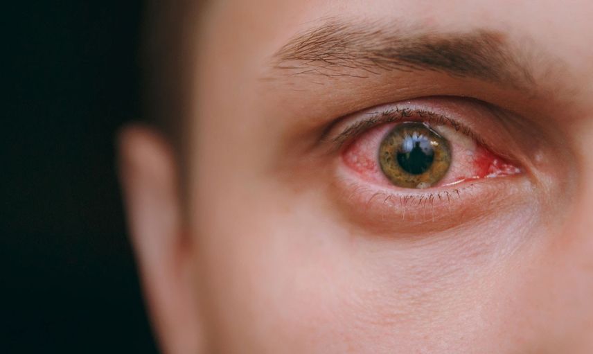 Retina Yırtılması Nedir, Retina Yırtılması Nasıl Tedavi Edilir?