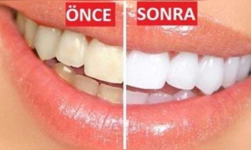 Sarı dişler nasıl beyazlatılır? Ev yapımı doğal ve bitkisel karışımlar ile sarı dişleri beyazlatma yöntemleri