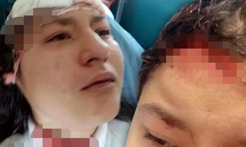 Selfie Kurbanı: Kastamonu'da 14 Yaşındaki Kız Çocuğuna 5 Köpek Saldırdı!