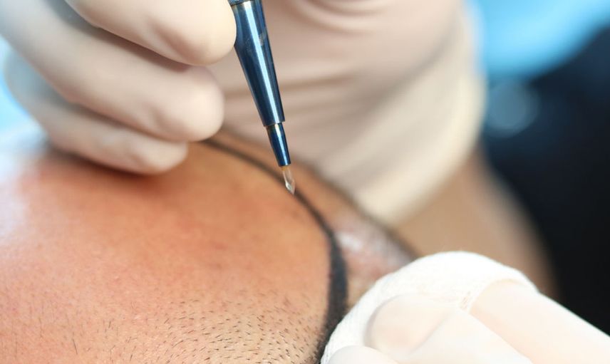 Smile Haır Clinic Uzman Doktoru Dr. Mehmet Erdoğan; Ütopik Sonuçlar Vaat Etmiyoruz