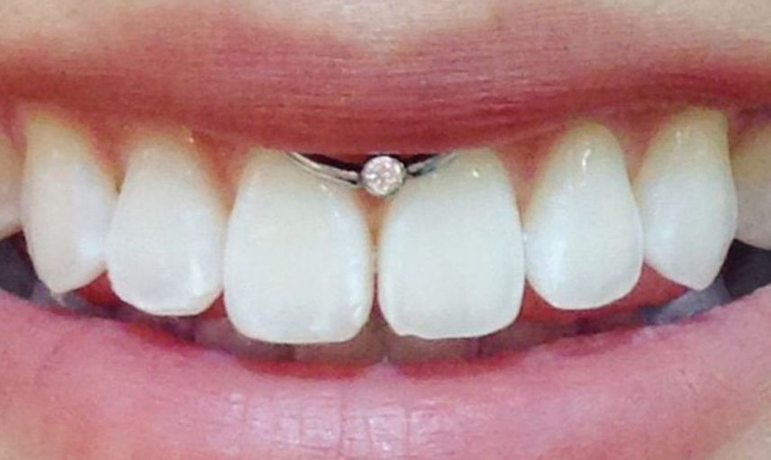 Smiley Piercing Zararları Nelerdir?