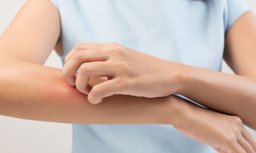 Uyuz hastalığı nedir, belirtileri neler? Uyuz hastalığında döküntü ve kaşıntıları geçirmek için öneriler