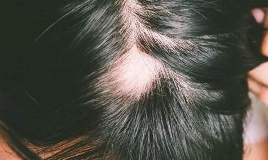 Will Smith’in karısının hastalığı Alopesi nedir? Alopecia sebepleri neler, neden olur, nasıl anlaşılır, tedavisi var mı?